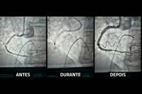 angioplastia-com-aterectomia-rotacional-procedimento-inedito-no-metropolitano-salva-paciente-idoso-2.jpg