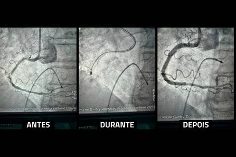 angioplastia-com-aterectomia-rotacional-procedimento-inedito-no-metropolitano-salva-paciente-idoso-2.jpg