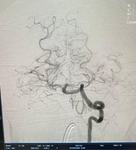 arteriografia-cerebral-2.jpeg