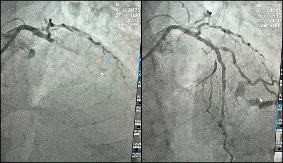coracao-paraibano_-hemodinamica-do-regional-de-patos-e-palco-da-primeira-angioplastia-coronariana-do-sertao-paraibano-4.jpg