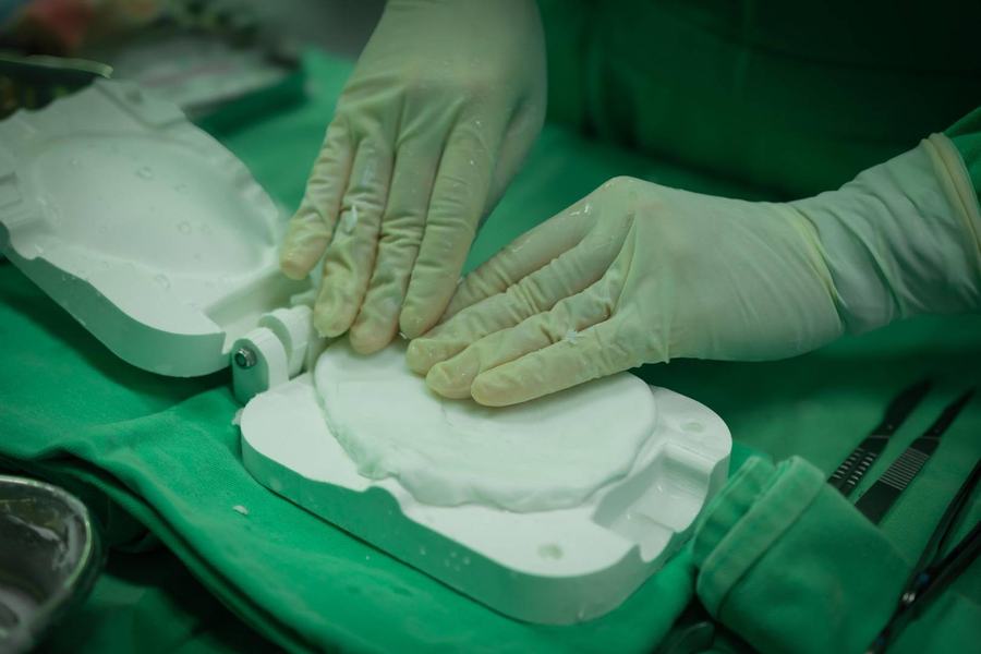 cranioplastia-com-protese-prototipada-5.jpeg