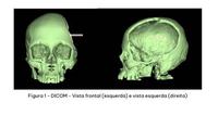 cranioplastia-com-protese-prototipada-6.jpeg