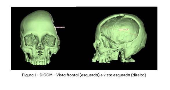 cranioplastia-com-protese-prototipada-6.jpeg