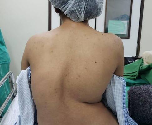 Governo amplia cirurgias de escoliose no Complexo Pediátrico Arlinda Marques e fortalece assistência especializada