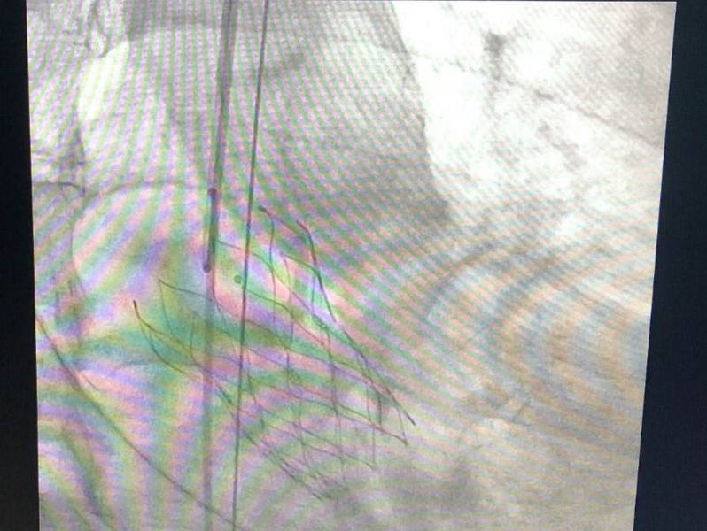 hemodinamica-do-hospital-metropolitano-realiza-primeiro-implante-transcateter-de-valvula-aortica-de-2024-2.jpeg