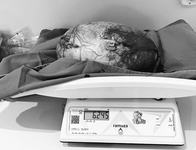 hospital-regional-de-guarabira-realiza-cirurgia-de-urgencia-para-retirada-de-cisto-ovariano-gigante-2.jpeg