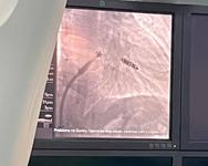 ineditismo-na-paraiba_-hospital-metropolitano-realiza-implante-de-marcapasso-com-tecnologia-recem-chegada-no-brasil-3.jpeg