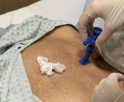 o-mielograma-e-feito-em-ambulatorio-pelo-hematologista.jpg