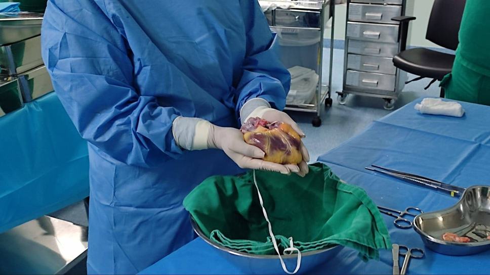 primeiro-transplante-de-coracao-de-2023-na-paraiba-e-realizado-no-hospital-metropolitano_3.jpeg