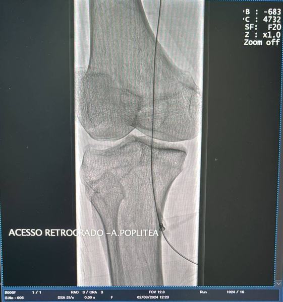 procedimento-inedito-na-hemodinamica-de-patos-salva-mais-um-paciente-no-sertao-da-paraiba-2.jpeg