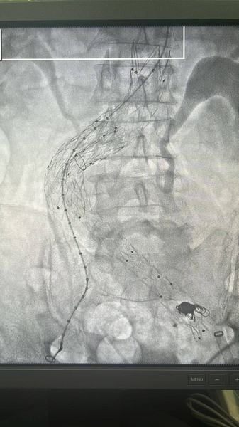 servico-de-hemodinamica-gerenciado-pela-pb-saude-realiza-procedimento-inedito-para-tratamento-de-aneurisma-raro-1.jpeg