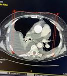 trombectomia-mecanica-1.jpg