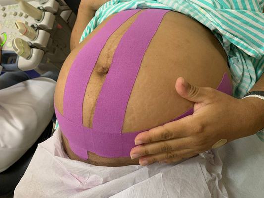 Maternidade Frei Damião oferece taping para pacientes e garante mais conforto na gestação e pós-operatório